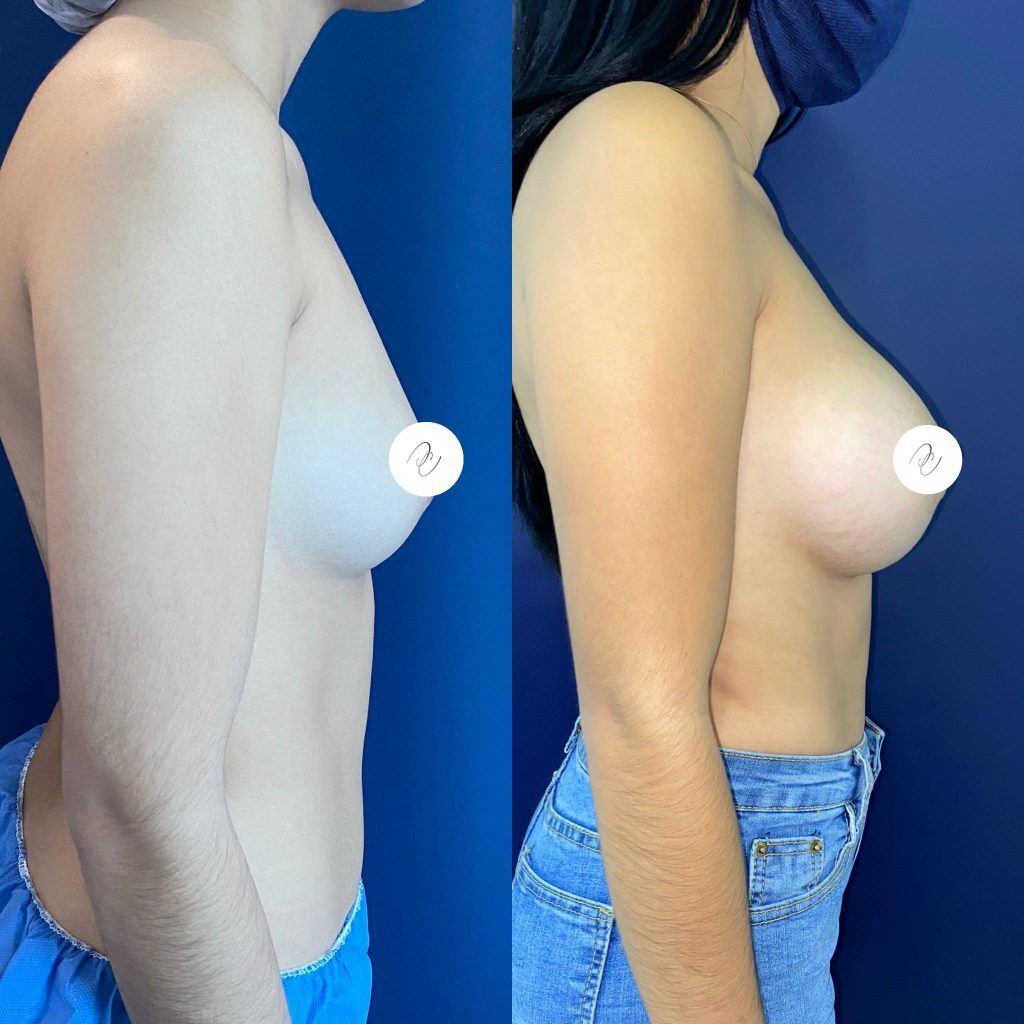 Mamoplastia – foto 1 | Dr. Diego Castañeda, cirujano plástico en Neiva
