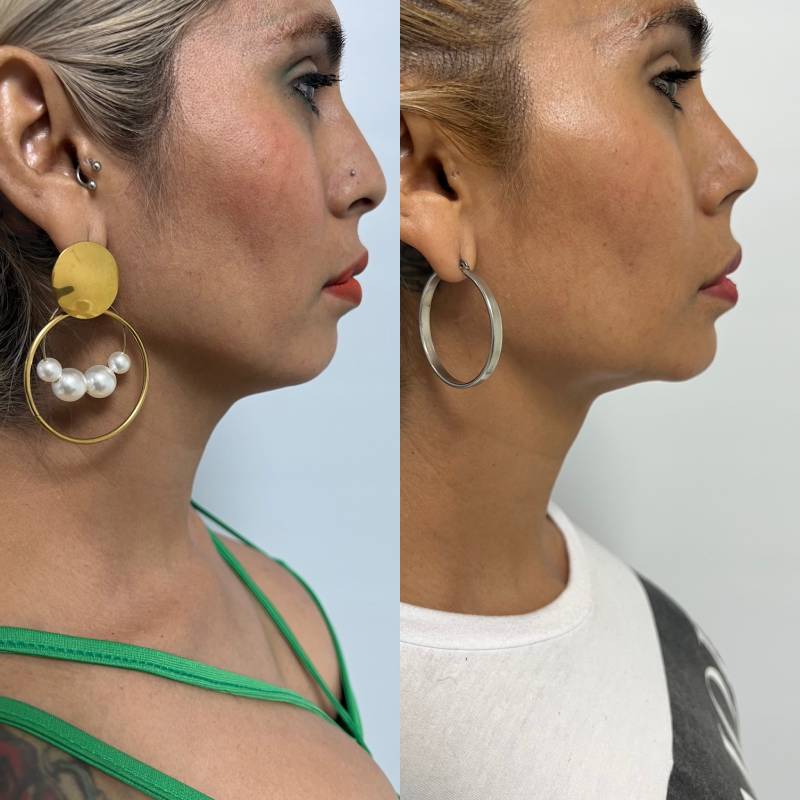 Feminización facial – foto 2 | Dr. Diego Castañeda, cirujano plástico en Neiva