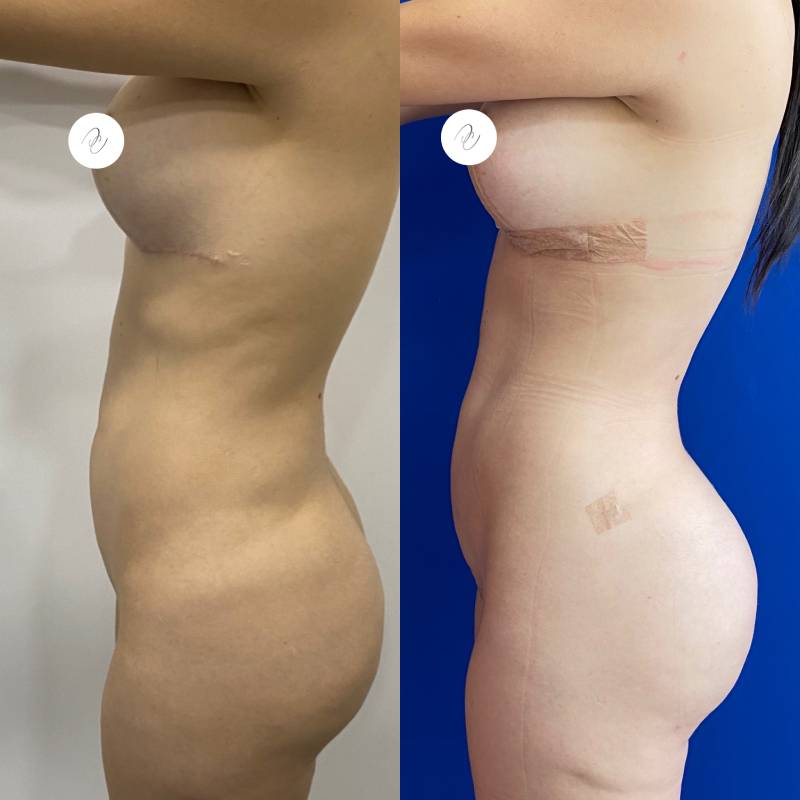 Gluteoplastia de aumento con implantes o mediante Lipotransferencia – foto 2 | Dr. Diego Castañeda, cirujano plástico en Neiva