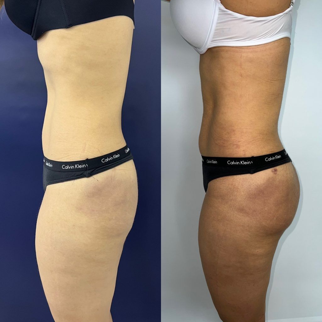 Gluteoplastia de aumento con implantes o mediante Lipotransferencia – foto 1 | Dr. Diego Castañeda, cirujano plástico en Neiva