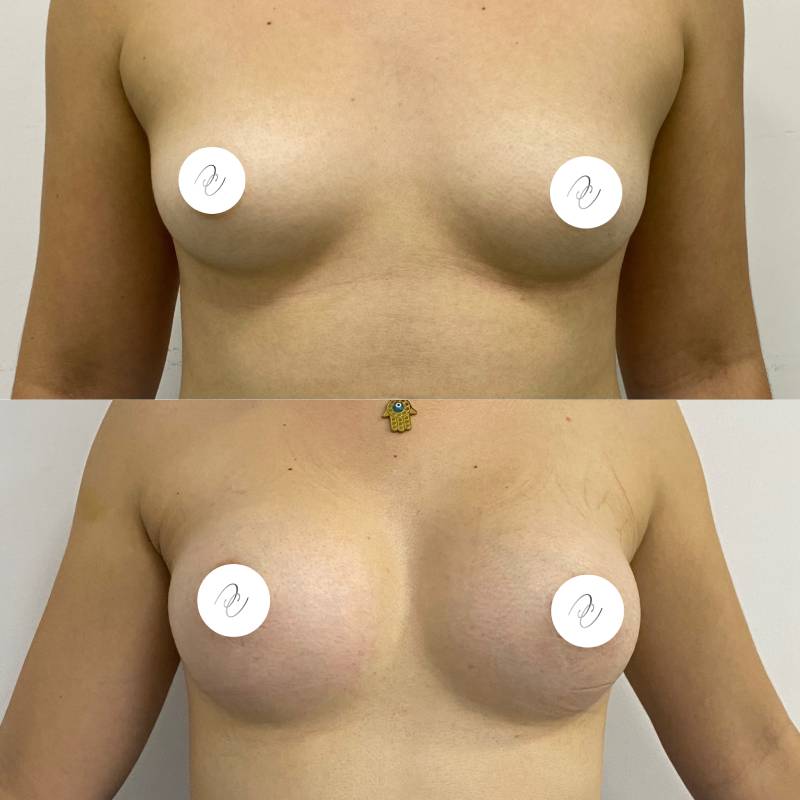 Mamoplastia – foto 2 | Dr. Diego Castañeda, cirujano plástico en Neiva