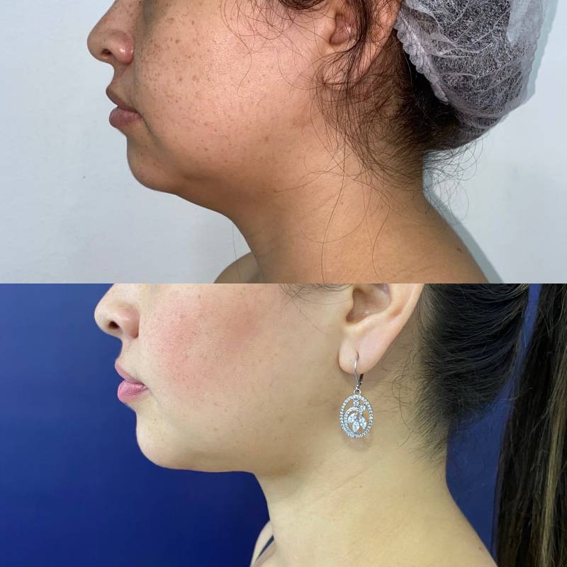 Bichectomía o Resección de bolsas grasas bucales – foto 3 | Dr. Diego Castañeda, cirujano plástico en Neiva