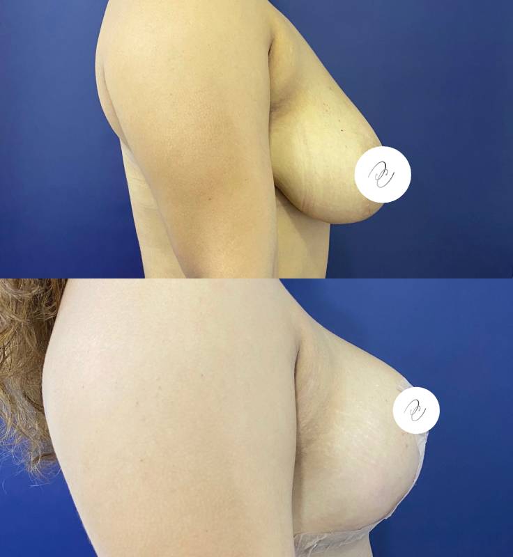 Mamoplastia de reducción – foto 2 | Dr. Diego Castañeda, cirujano plástico en Neiva