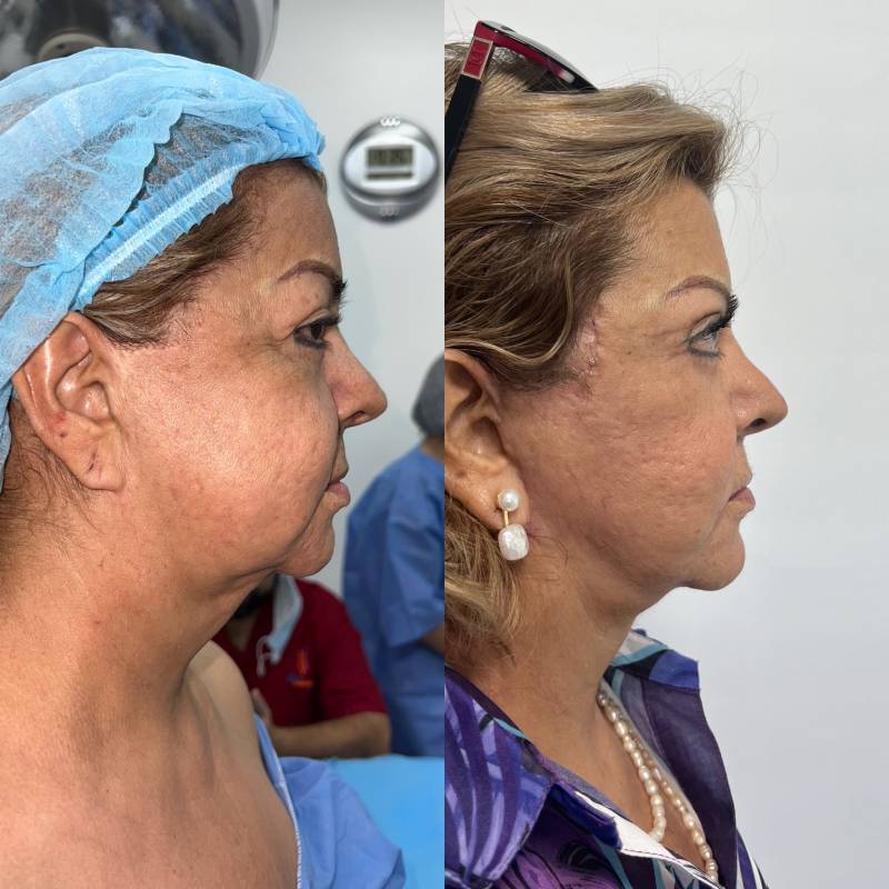 Ritidoplastia o lifting facial – foto 2 | Dr. Diego Castañeda, cirujano plástico en Neiva