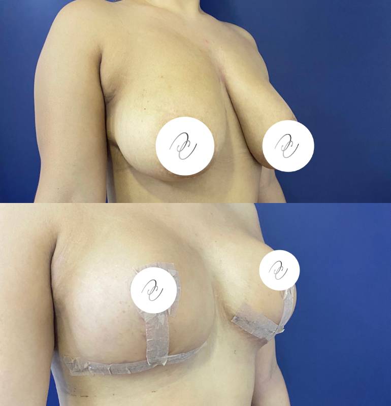 Mamoplastia de reducción – foto 3 | Dr. Diego Castañeda, cirujano plástico en Neiva