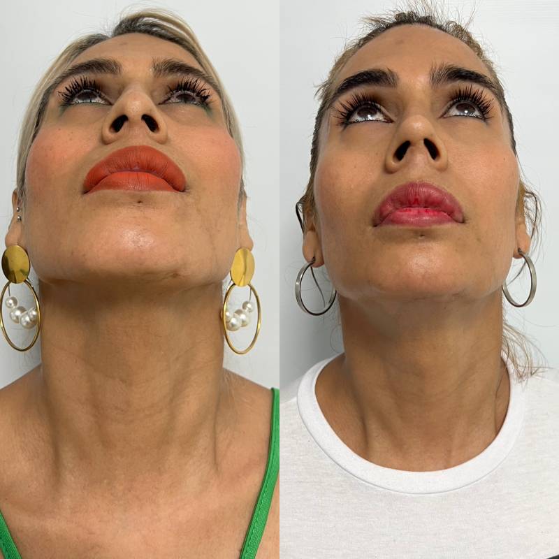 Feminización facial – foto 3 | Dr. Diego Castañeda, cirujano plástico en Neiva