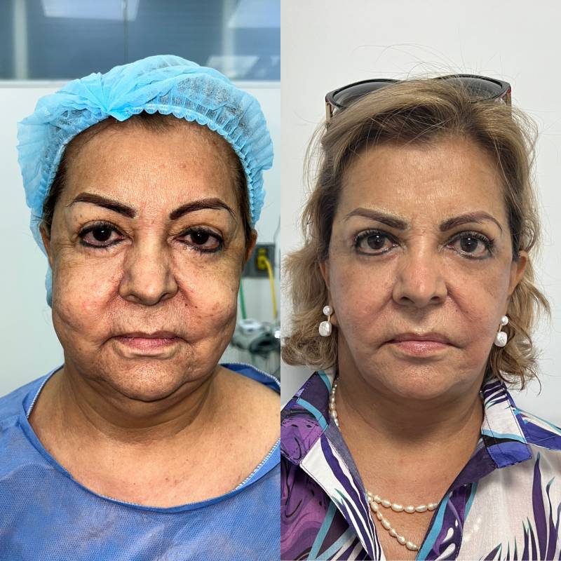 Ritidoplastia o lifting facial – foto 3 | Dr. Diego Castañeda, cirujano plástico en Neiva