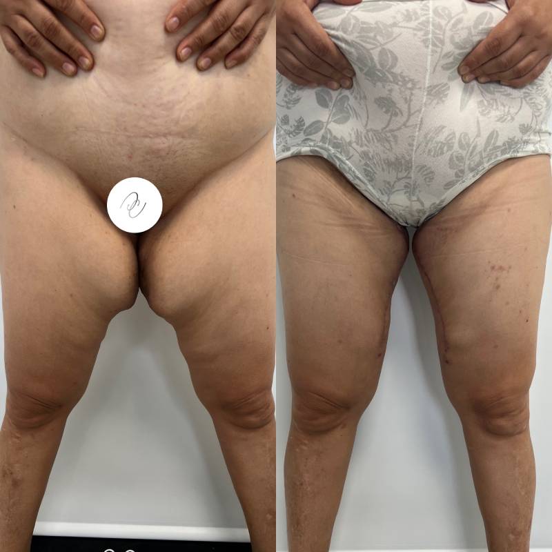 Levantamiento de muslos o cruroplastia – foto 3 | Dr. Diego Castañeda, cirujano plástico en Neiva
