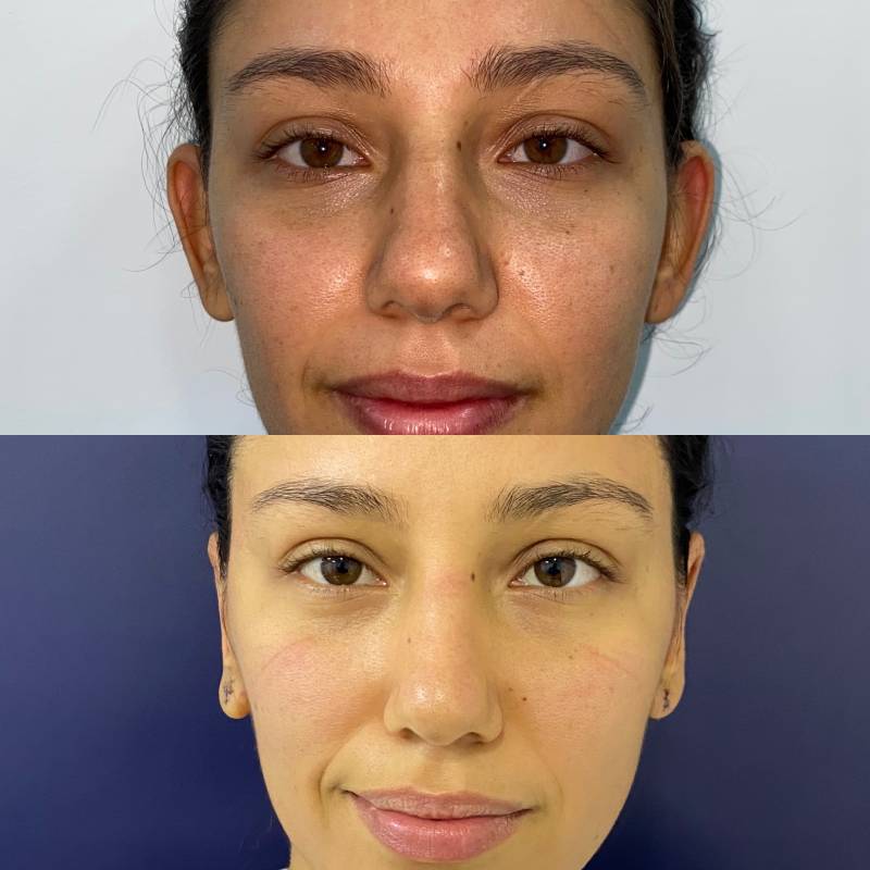 Otoplastia o Cirugía de Orejas – foto 3 | Dr. Diego Castañeda, cirujano plástico en Neiva