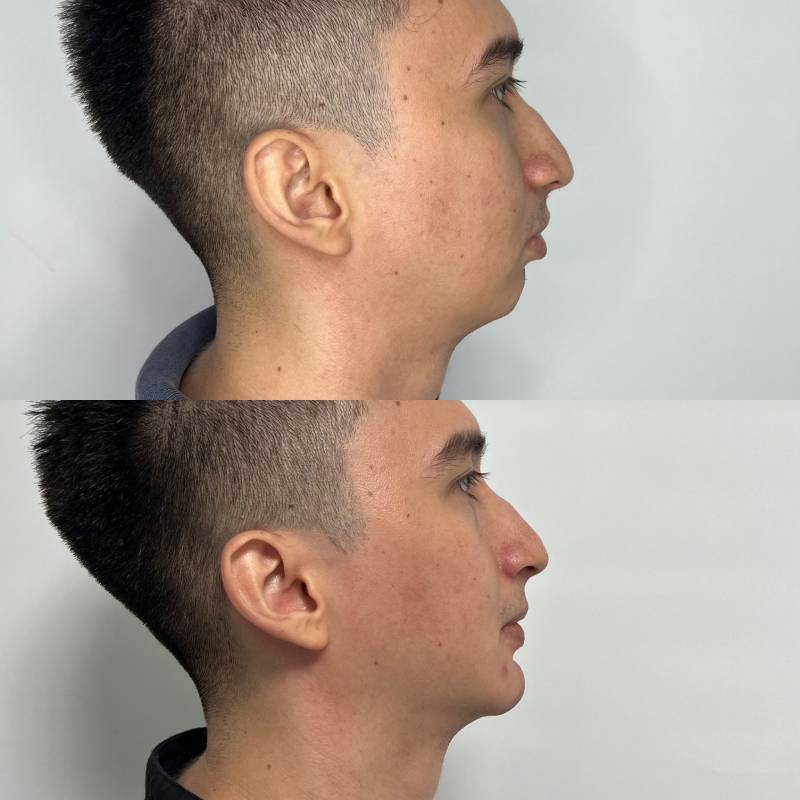 Mentoplastia – foto 2 | Dr. Diego Castañeda, cirujano plástico en Neiva