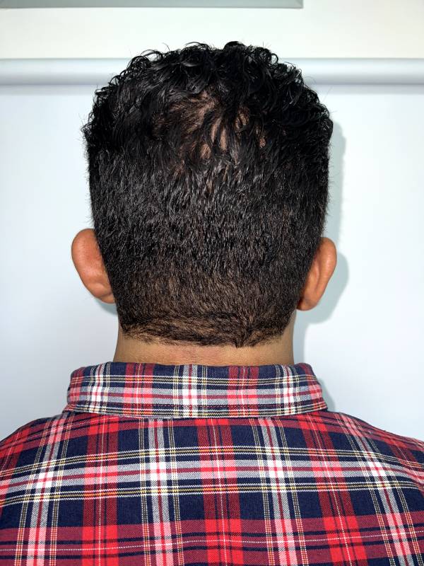 Otoplastia o Cirugía de Orejas – foto 1 | Dr. Diego Castañeda, cirujano plástico en Neiva