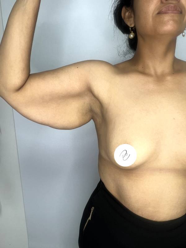 Levantamiento de brazos o braquioplastia – foto 1 | Dr. Diego Castañeda, cirujano plástico en Neiva