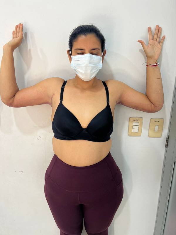 Levantamiento de brazos o braquioplastia – foto 2 | Dr. Diego Castañeda, cirujano plástico en Neiva