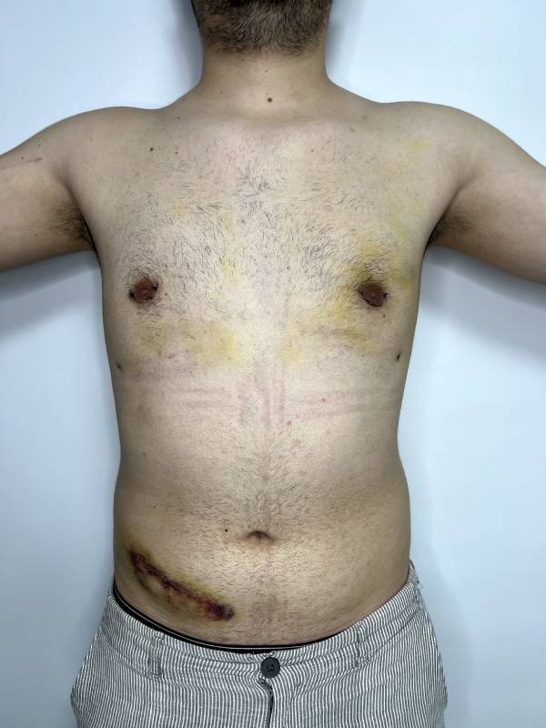 Resección de Ginecomastia – foto 2 | Dr. Diego Castañeda, cirujano plástico en Neiva