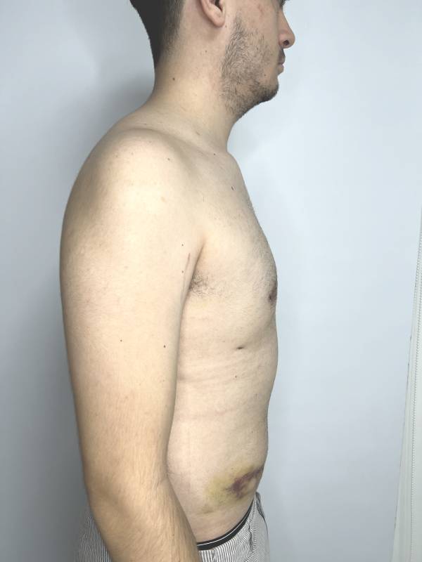 Resección de Ginecomastia – foto 4 | Dr. Diego Castañeda, cirujano plástico en Neiva