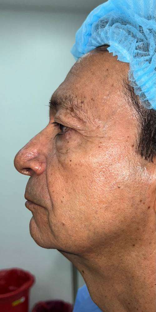 Blefaroplastia o Cirugía de Párpados – antes del procedimiento | Dr. Diego Castañeda, cirujano plástico en Neiva