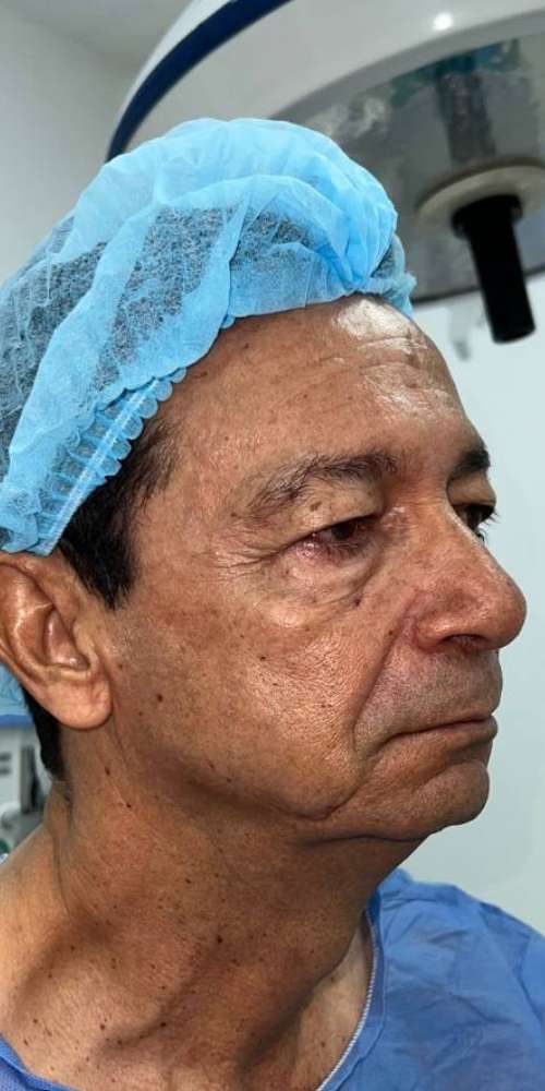 Blefaroplastia o Cirugía de Párpados – antes del procedimiento | Dr. Diego Castañeda, cirujano plástico en Neiva
