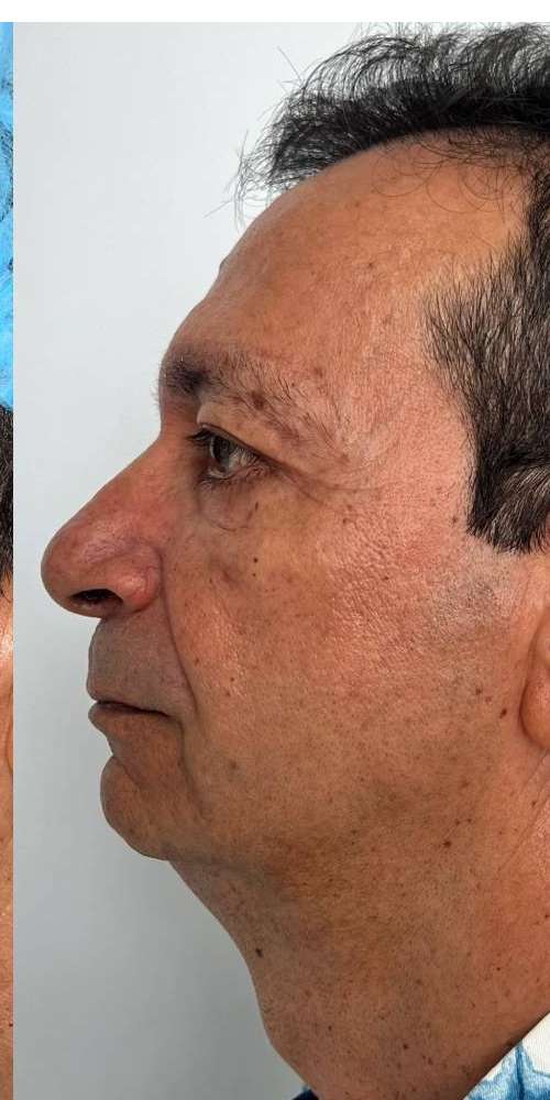 Blefaroplastia o Cirugía de Párpados – después del procedimiento | Dr. Diego Castañeda, cirujano plástico en Neiva