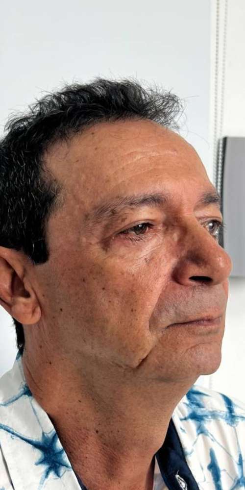 Blefaroplastia o Cirugía de Párpados – después del procedimiento | Dr. Diego Castañeda, cirujano plástico en Neiva