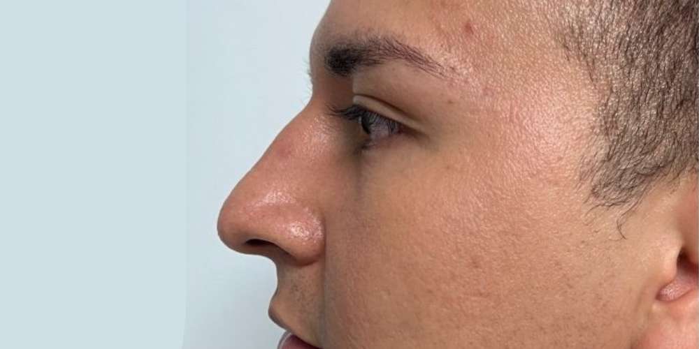 Rinoplastia Estética, Estructural y Funcional – antes del procedimiento | Dr. Diego Castañeda, cirujano plástico en Neiva
