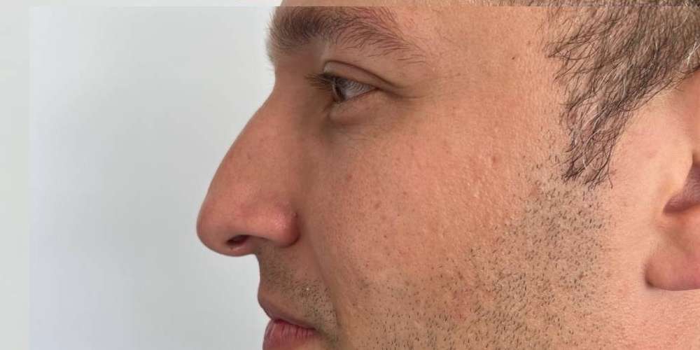Rinoplastia Estética, Estructural y Funcional – antes del procedimiento | Dr. Diego Castañeda, cirujano plástico en Neiva