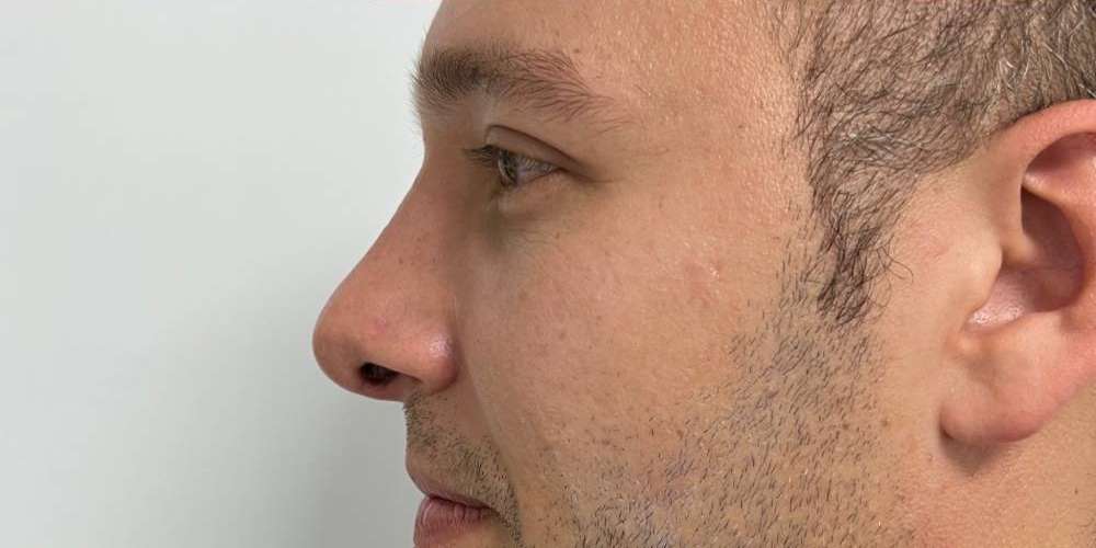 Rinoplastia Estética, Estructural y Funcional – después del procedimiento | Dr. Diego Castañeda, cirujano plástico en Neiva