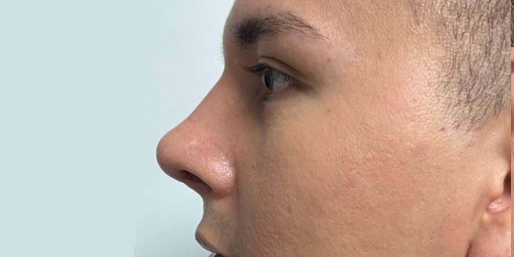 Rinoplastia Estética, Estructural y Funcional – después del procedimiento | Dr. Diego Castañeda, cirujano plástico en Neiva
